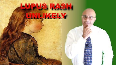 Lupus: The Malar/Butterfly Rash