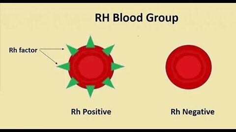 The RH Negative Blood Type: Missing Rhesus 13 Gene! Missing RhD Gene!