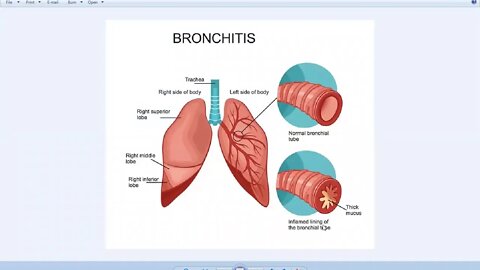 Class 10th Biology Bronchitis Lecture 7 Zoom Online 7 July 2020