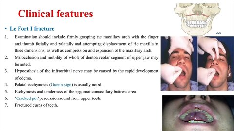 Oral Surgery L4 (Part1 & Part2) (Fractures of the middle third of the facial skeleton)