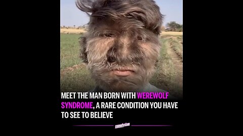 This Man has a Rare Condition called Werewolf Syndrome