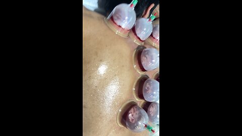 Cupping