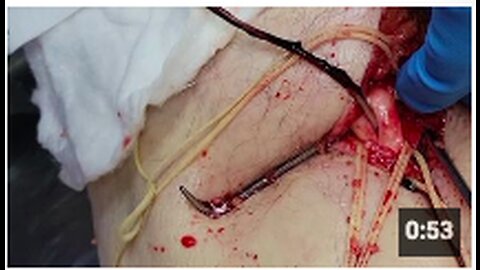 Unbelievable blood clots: video from embalmer Richard Hirschman