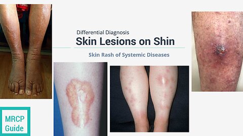 SKIN RASHES ON SHIN - DIFFERENTIAL DIAGNOSIS IN SYSTEMIC ILLNESSES