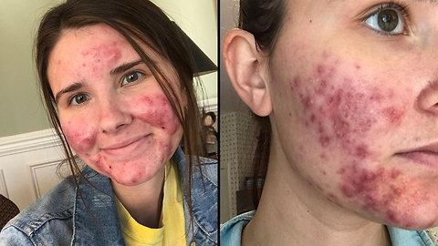 Going Out With My Severe Acne For The First Time | SHAKE MY BEAUTY