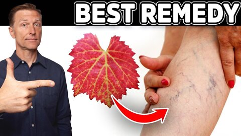 The #1 Remedy for Varicose Veins (Venous Insufficiency) - Dr. Berg