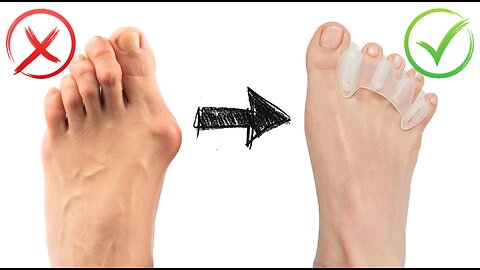 BUILD HEALTHY FEET - Best Toe Spacers