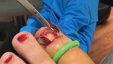 remoção de unha encravada asmr | ingrown toenail removal #podiatrist #ingrown_toenail #podologia