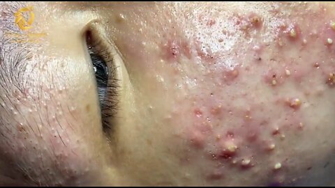 Acne Treatment | Giant Acne