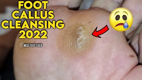 FOOT CALLUS REMOVAL 2022 (PAINLESS PROCEDURE) | SATISFYING CALLOUS TREATMENT BY MISS FOOT FIXER