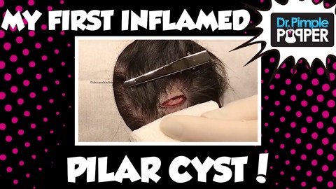 Dr Pimple Popper: My First INFLAMED Pilar Cyst! A Popaholic Squeeze!