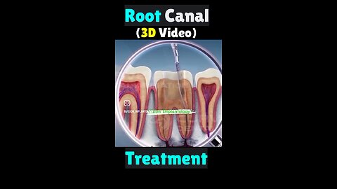 Root Canal Treatment