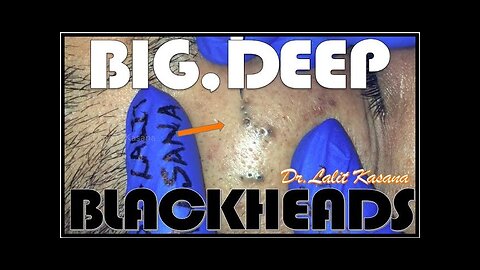 BIG DEEP BLACKHEADS REMOVAL