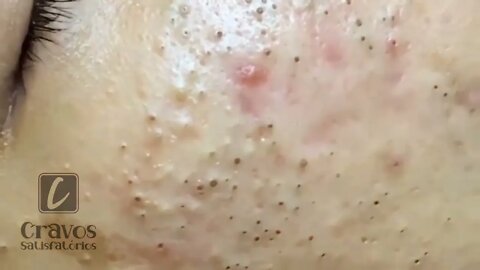 Removing giant blackheads!! acne blackhead whitehead