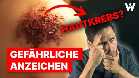 5 Anzeichen für Hautkrebs: Selbst die Gefahr erkennen - ABCDE-Regel!@ DoktorWeigl