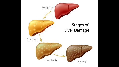 The 6 Best Ways to Heal a Fatty Liver