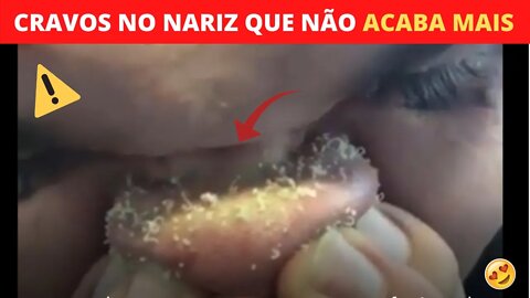 Removendo Cravos e Espinhas Gigantes Do Rosto satisfatório demais - giant blackheads and pimples