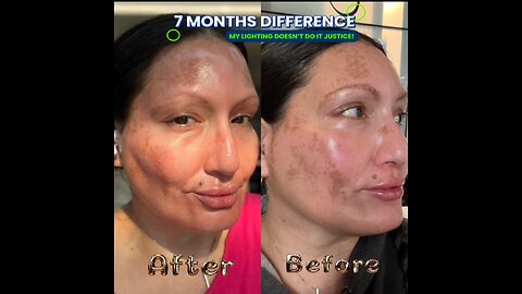 Hydroquinone Microneedling Treatment at Fresh Faces Rx