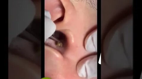 🦯🤢🥵 Remoção de cravo enorme da orelha!! ear blackhead removal!! Relaxe!! Relax!!