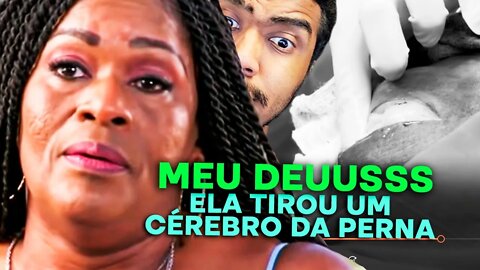 UM CAROÇO CANTOR NA COXA | DRA. SANDRA LEE: A RAINHA DOS CRAVOS