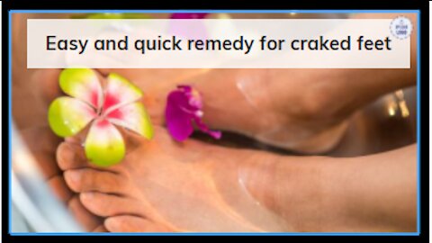 Quick And Easy Remedy For Cracked Feet