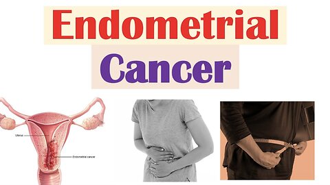 Endometrial Cancer | Risk Factors, Pathogenesis, Signs & Symptoms, Diagnosis, Treatment, Prevention