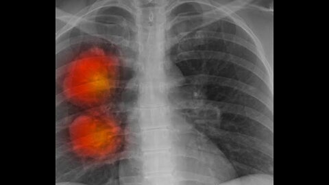 AI Tools Spots Cancers Missed By Doctor |BBC News