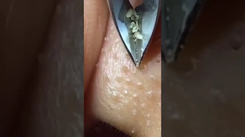 Remoção de Cravos e Espinhas - Remove Squeezing Blackheads and Pimples - Just Relax | Apenas Relaxe