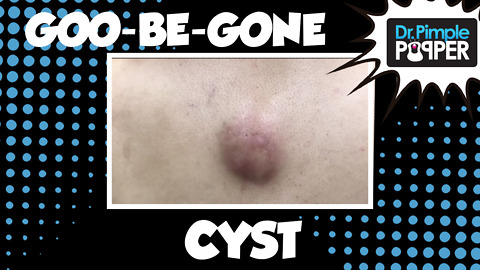 Goo-Be-Gone Cyst