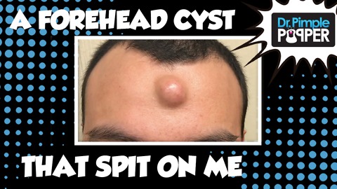 A Forehead Cyst That Spit On Me!