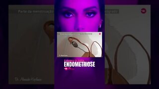 ENDOMETRIOSE - A doença da Anitta