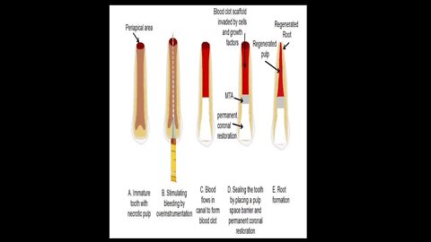 Pedodontics L6 (Part2) & L7 (Regenerative Endodontic & MTA)