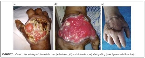 The Power of Ozone Therapy For Diabetic Non Healing Wounds