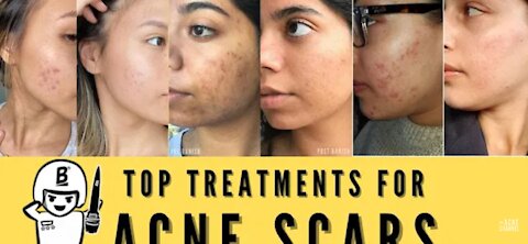 WAYS TO GET RID OF ACNE SCARS PERMANENTLY.