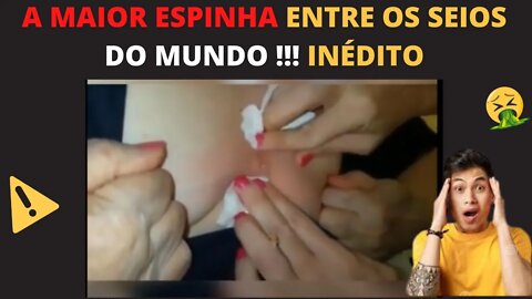 ESPREMENDO CRAVO ENORME VÍDEO INCRÍVEL REMOVENDO CRAVOS E ESPINHAS SATISFATÓRIO PIMPLES REMOVAL