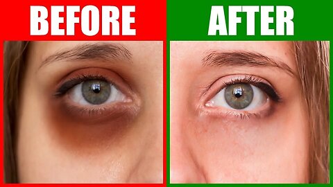 How To Rid Dark Circles Naturally in 24 Hours