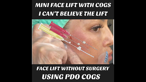 Mini Face Lift Using PDO Cogs, Without Surgery