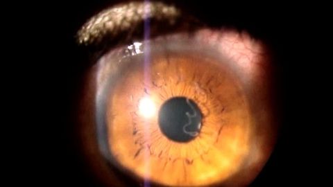 Woman Has Worm In Eyeball