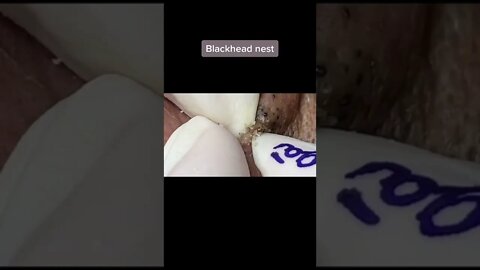 CRAZY BLACKHEAD NEST gets removed 😰 #blackheadremoval #blackhead #blackheads #blackheadsremover