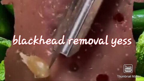 Blackhead removal satisfying video #2