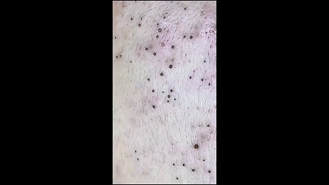 Blackheads episode 26