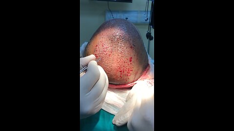 Hair Transplant