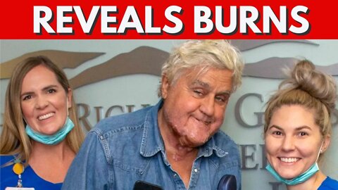 JAY LENO RELEASED FROM BURN CENTER. PROGNOSIS GOOD!