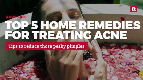 5 home remedies for treating acne | Rare Life