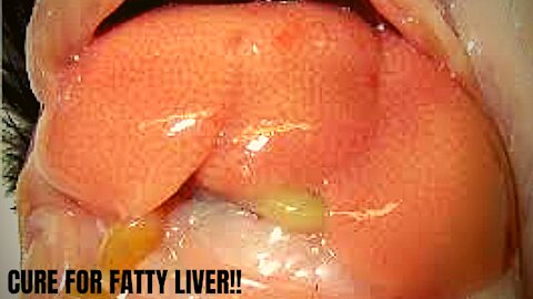 CURE FOR FATTY LIVER!!!!