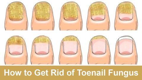 How to Get Rid of Toenail Fungus Fast and Naturally