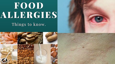 5 Notable Facts About Food Allergies