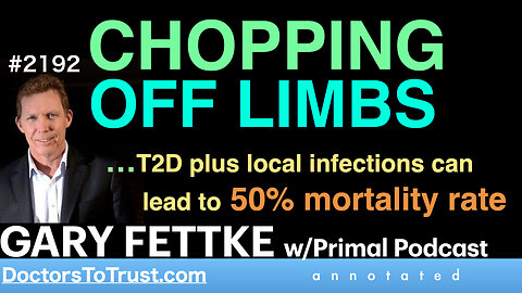 GARY FETTKE f2 | CHOPPING OFF LIMBS …T2D plus local infections can lead to 50% mortality rate