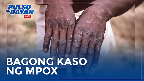 DOH, muli na namang nakapagtala ng bagong kaso ng mpox