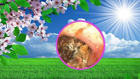 Cholesteatoma Earwax Removal #03